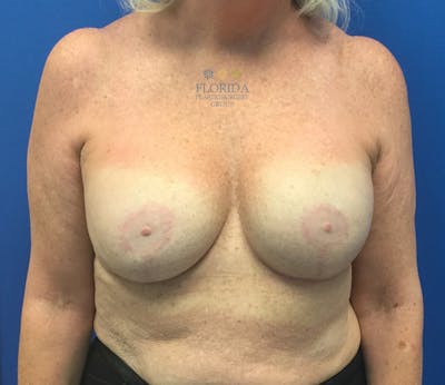 Revision Breast Surgery Before & After Gallery - Patient 154993587 - Image 2