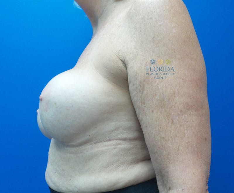 Revision Breast Surgery Before & After Gallery - Patient 154993587 - Image 3