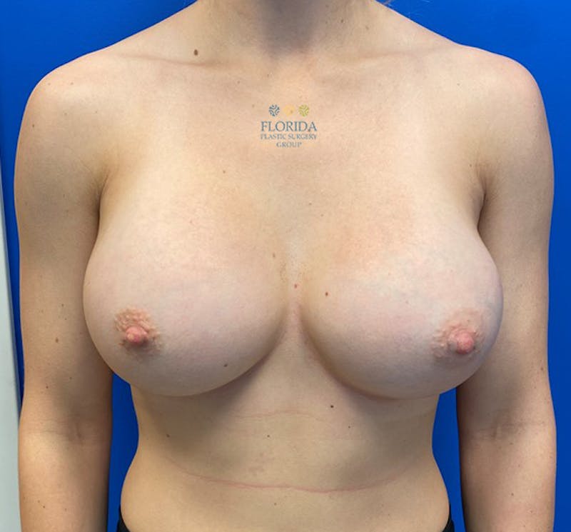 Silicone Breast Augmentation Before & After Gallery - Patient 154993589 - Image 2