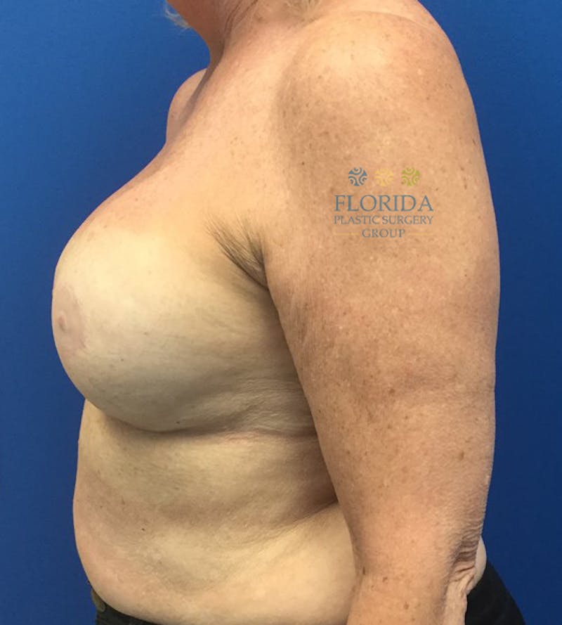 Revision Breast Surgery Before & After Gallery - Patient 154993587 - Image 4
