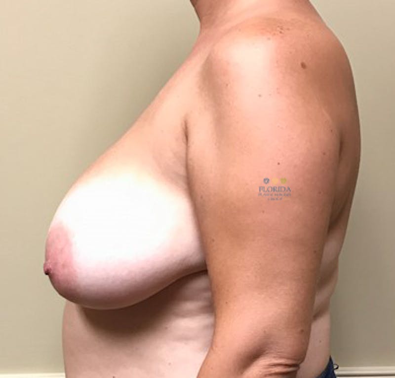 Breast Reduction Before & After Gallery - Patient 154993586 - Image 3