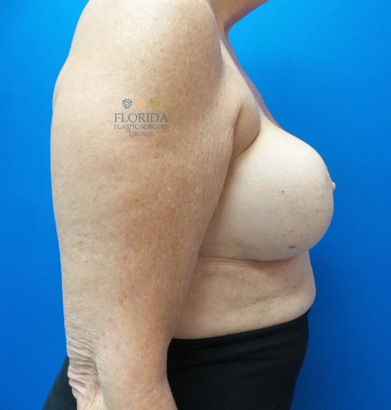 Revision Breast Surgery Before & After Gallery - Patient 154993587 - Image 5
