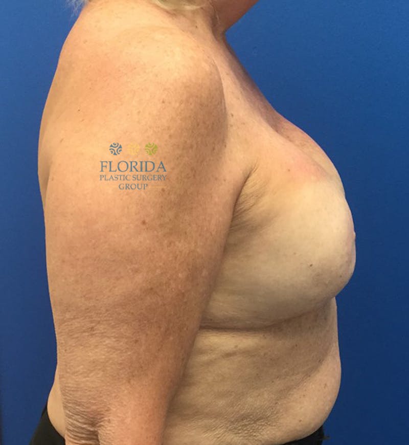 Revision Breast Surgery Before & After Gallery - Patient 154993587 - Image 6
