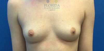 Silicone Breast Augmentation Before & After Gallery - Patient 154993594 - Image 1