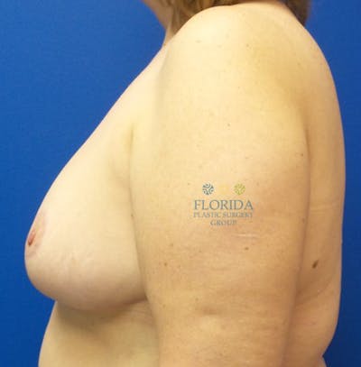 Breast Reduction Before & After Gallery - Patient 154993593 - Image 2