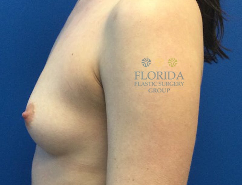 Silicone Breast Augmentation Before & After Gallery - Patient 154993594 - Image 3