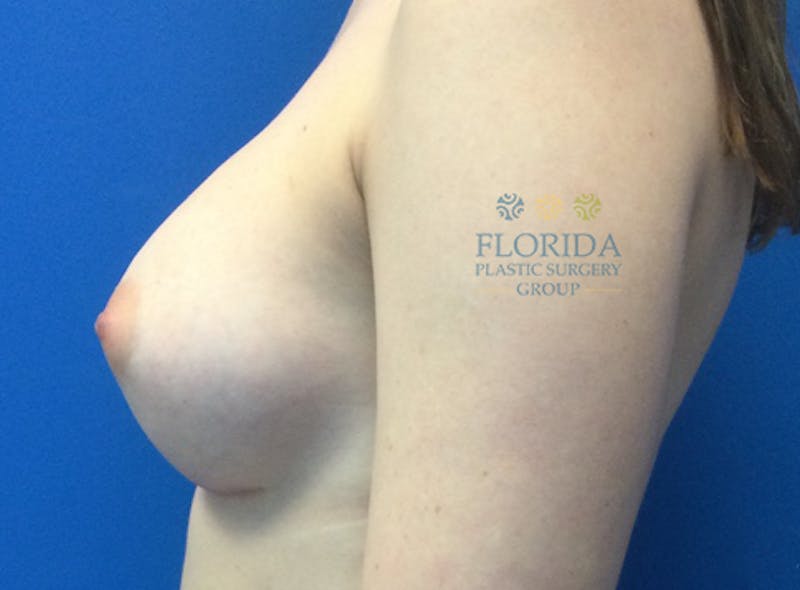 Silicone Breast Augmentation Before & After Gallery - Patient 154993594 - Image 4