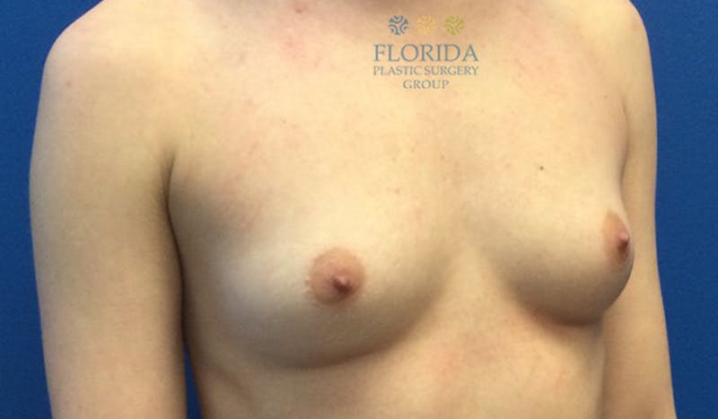 Silicone Breast Augmentation Before & After Gallery - Patient 154993594 - Image 5