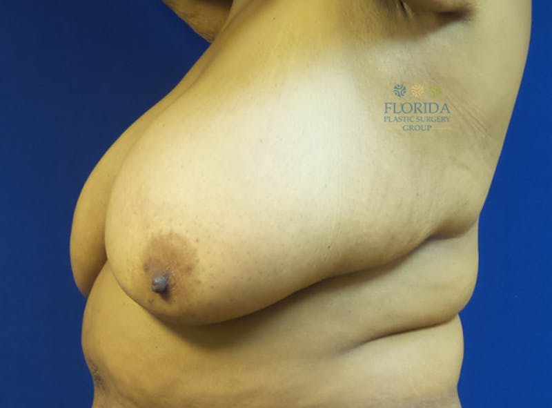 Breast Reduction Before & After Gallery - Patient 154993595 - Image 3