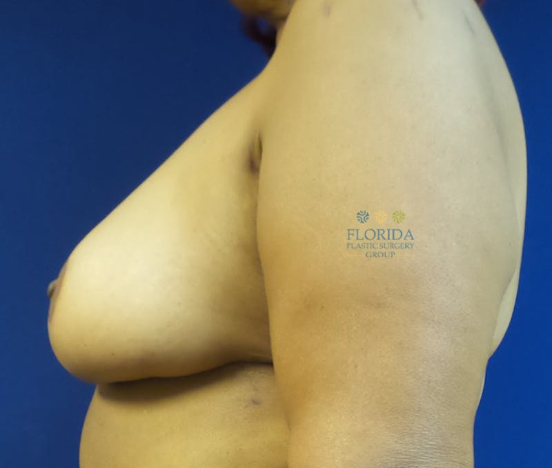 Breast Reduction Before & After Gallery - Patient 154993595 - Image 4