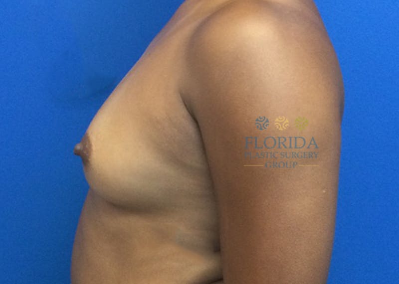 Silicone Breast Augmentation Before & After Gallery - Patient 154993600 - Image 3
