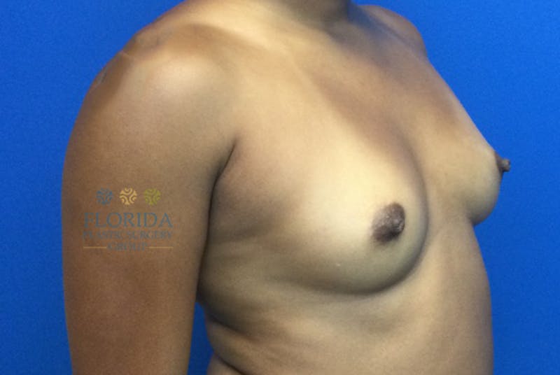 Silicone Breast Augmentation Before & After Gallery - Patient 154993600 - Image 5