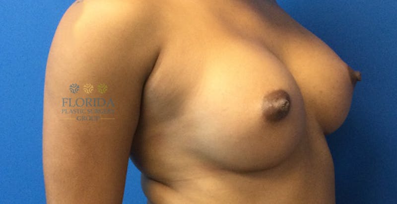 Silicone Breast Augmentation Before & After Gallery - Patient 154993600 - Image 6
