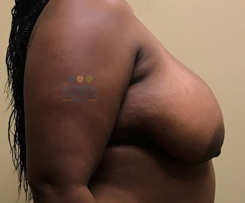 Breast Reduction Before & After Gallery - Patient 154993602 - Image 3