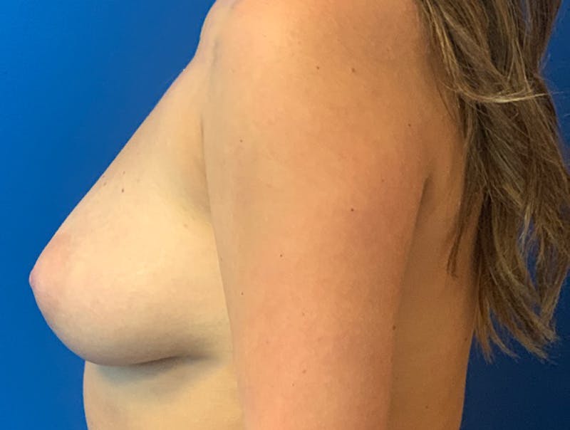 Silicone Breast Augmentation Before & After Gallery - Patient 154993603 - Image 3