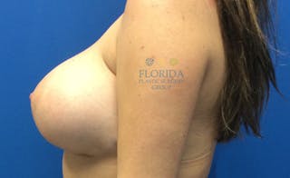 Silicone Breast Augmentation Before & After Gallery - Patient 154993603 - Image 4