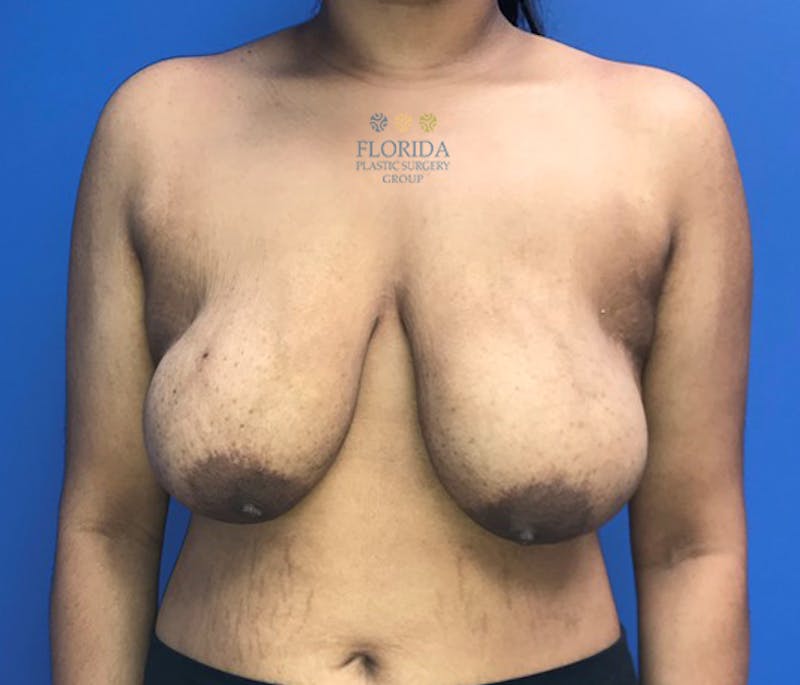 Breast Reduction Before & After Gallery - Patient 154993604 - Image 1