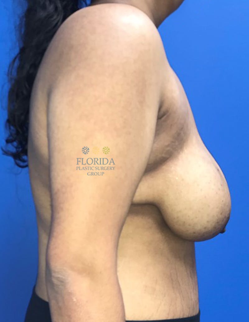 Breast Reduction Before & After Gallery - Patient 154993604 - Image 3