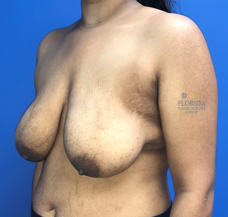 Breast Reduction Before & After Gallery - Patient 154993604 - Image 5