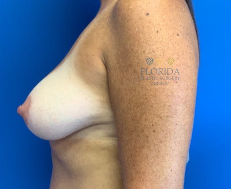 Silicone Breast Augmentation Before & After Gallery - Patient 154993616 - Image 5