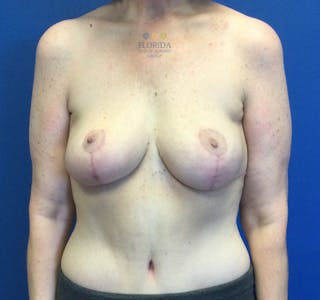 Breast Reduction Before & After Gallery - Patient 154993617 - Image 2