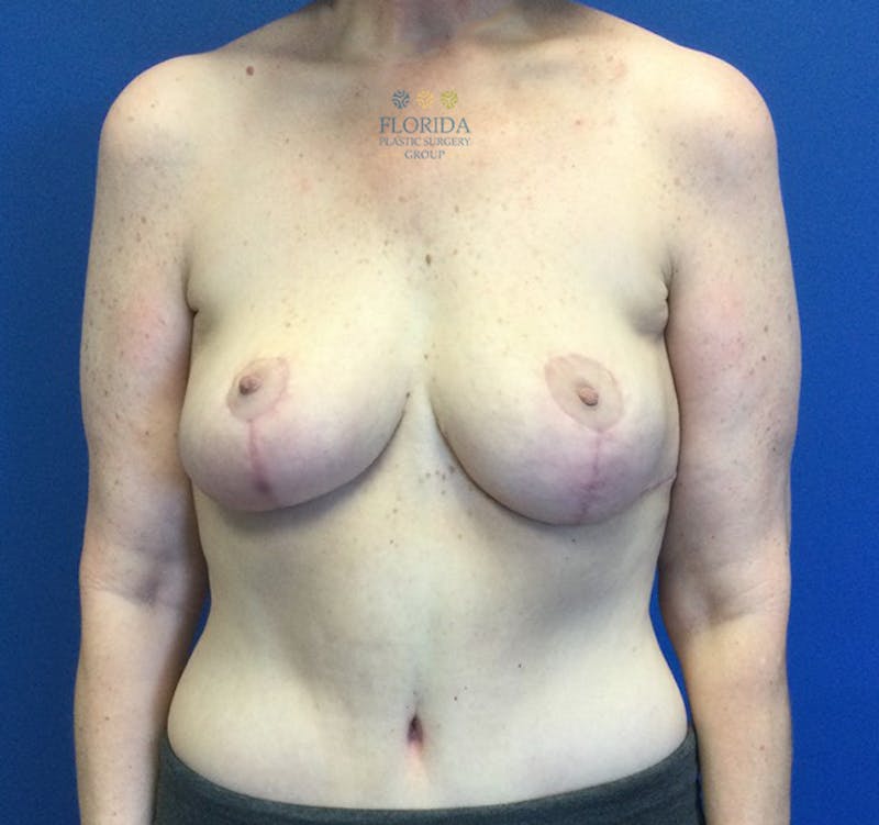 Breast Reduction Before & After Gallery - Patient 154993617 - Image 2