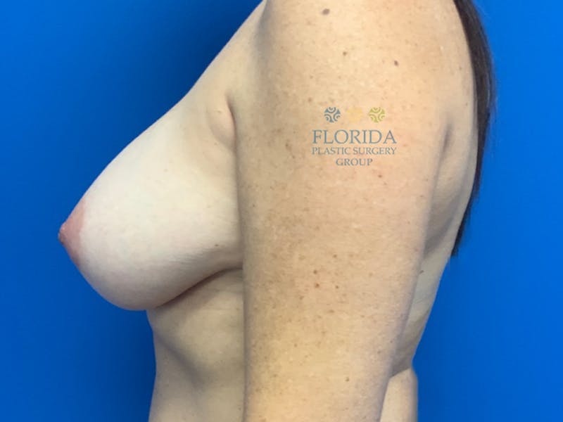 Silicone Breast Augmentation Before & After Gallery - Patient 154993616 - Image 6