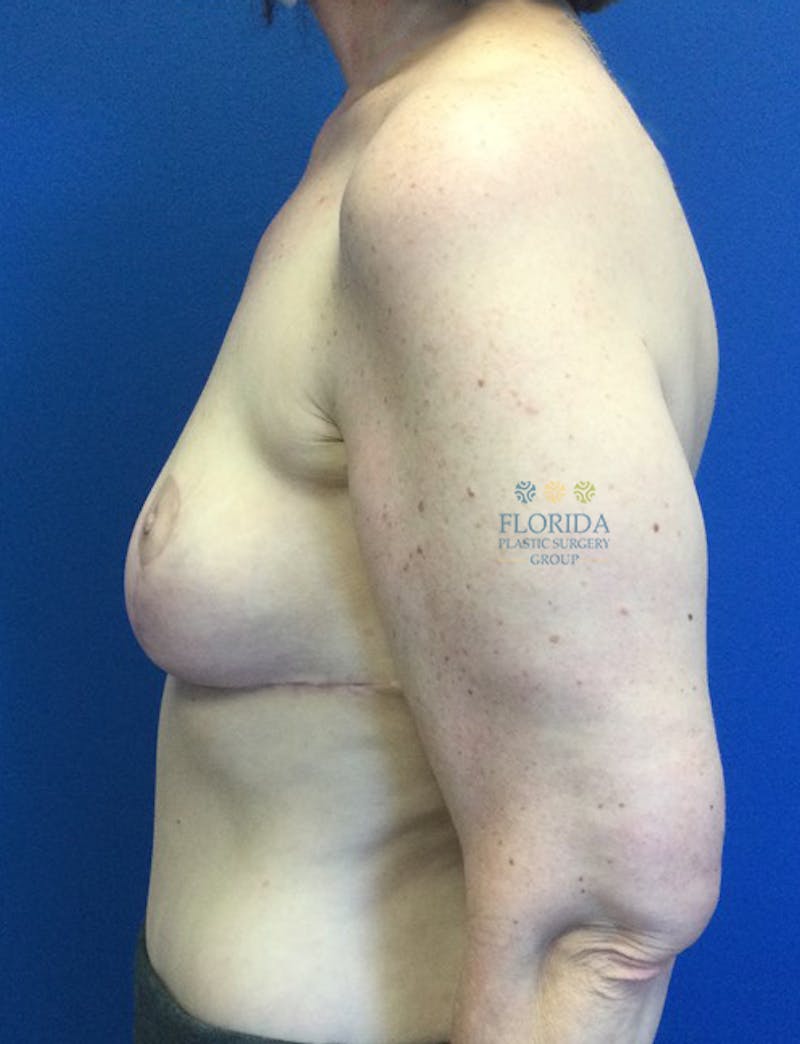 Breast Reduction Before & After Gallery - Patient 154993617 - Image 4