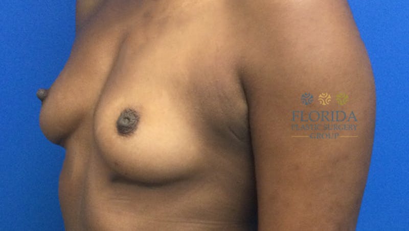 Silicone Breast Augmentation Before & After Gallery - Patient 154993621 - Image 1