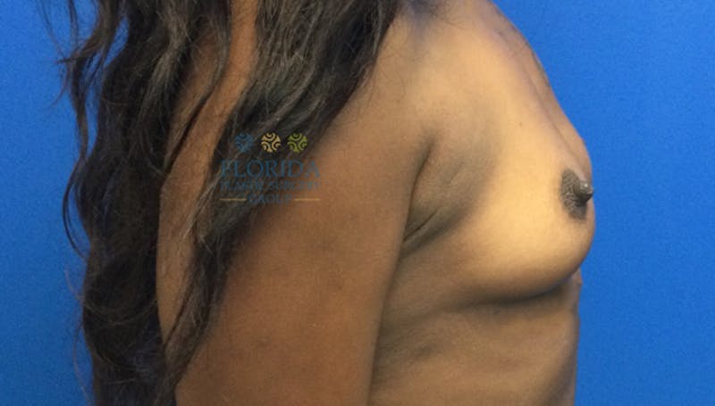 Silicone Breast Augmentation Before & After Gallery - Patient 154993621 - Image 3