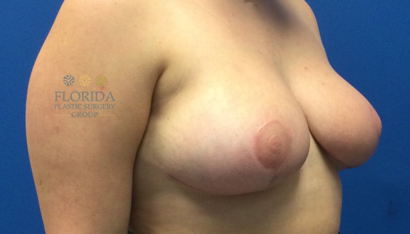 Breast Reduction Before & After Gallery - Patient 154993622 - Image 4