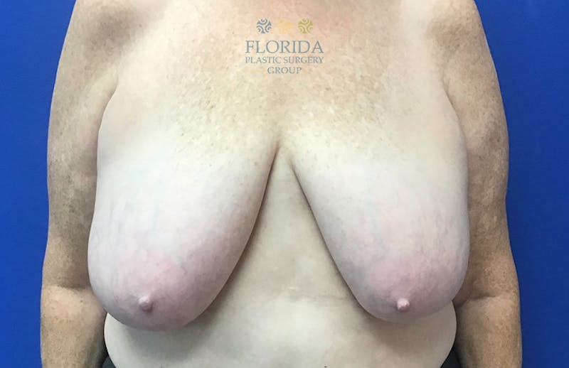 Breast Reduction Before & After Gallery - Patient 154993624 - Image 1
