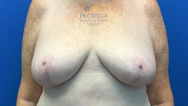 Breast Reduction Before & After Gallery - Patient 154993624 - Image 2