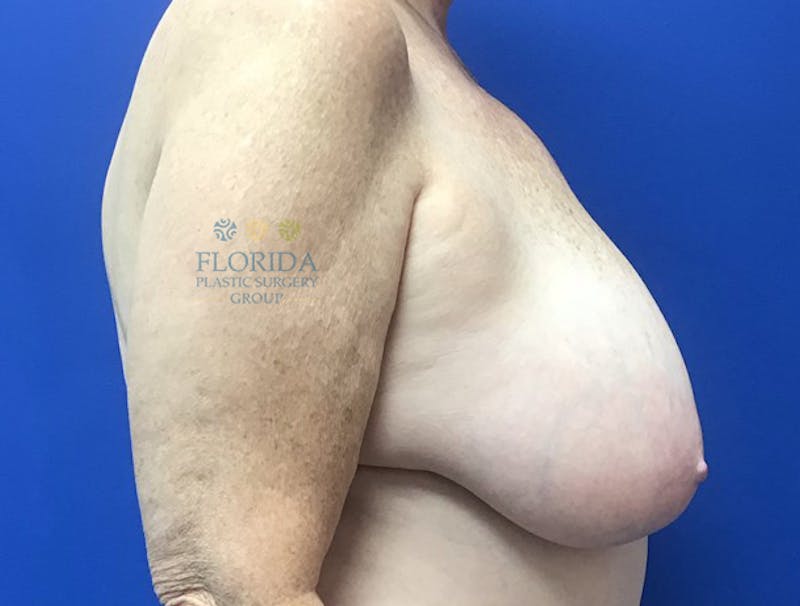 Breast Reduction Before & After Gallery - Patient 154993624 - Image 3