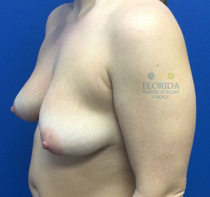 Silicone Breast Augmentation Before & After Gallery - Patient 154993625 - Image 3