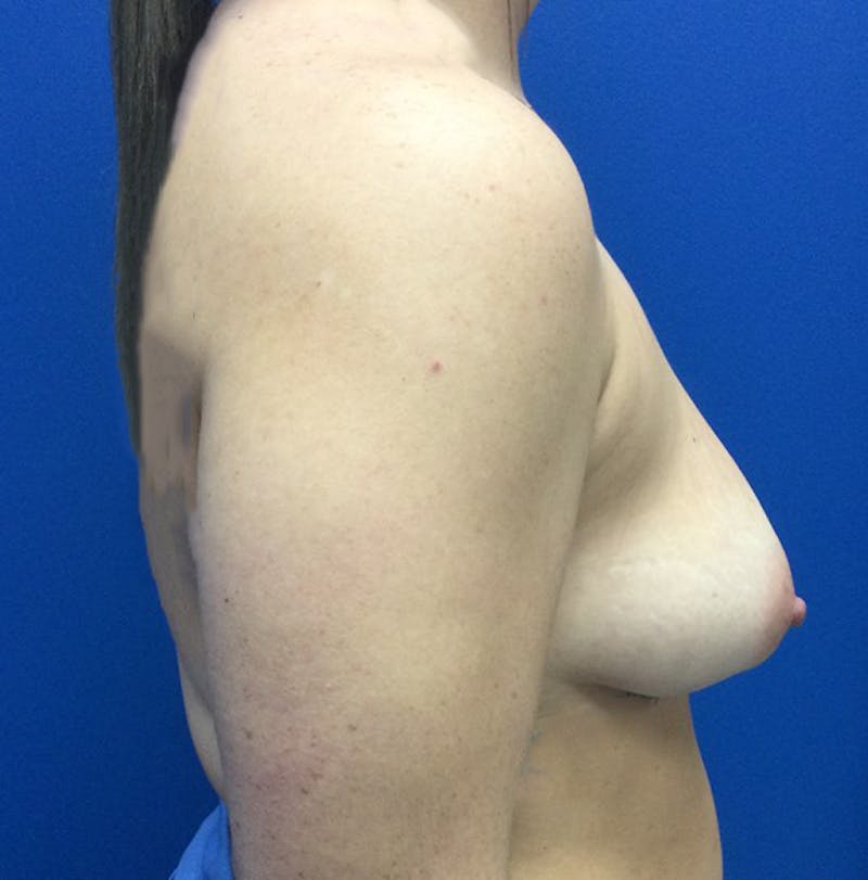 Silicone Breast Augmentation Before & After Gallery - Patient 154993625 - Image 5