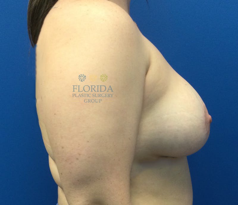Silicone Breast Augmentation Before & After Gallery - Patient 154993625 - Image 6