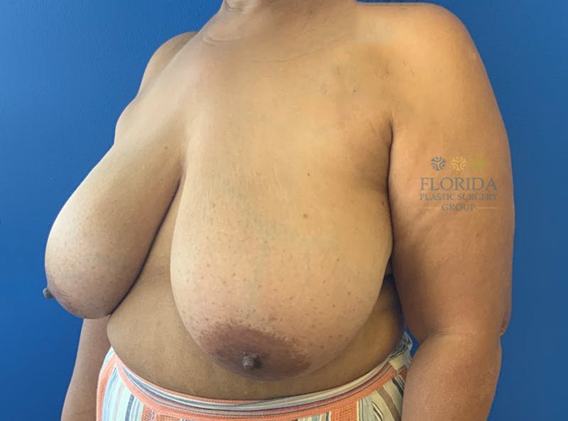 Breast Reduction Before & After Gallery - Patient 154993626 - Image 3