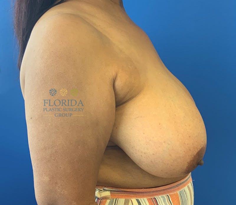 Breast Reduction Before & After Gallery - Patient 154993626 - Image 5