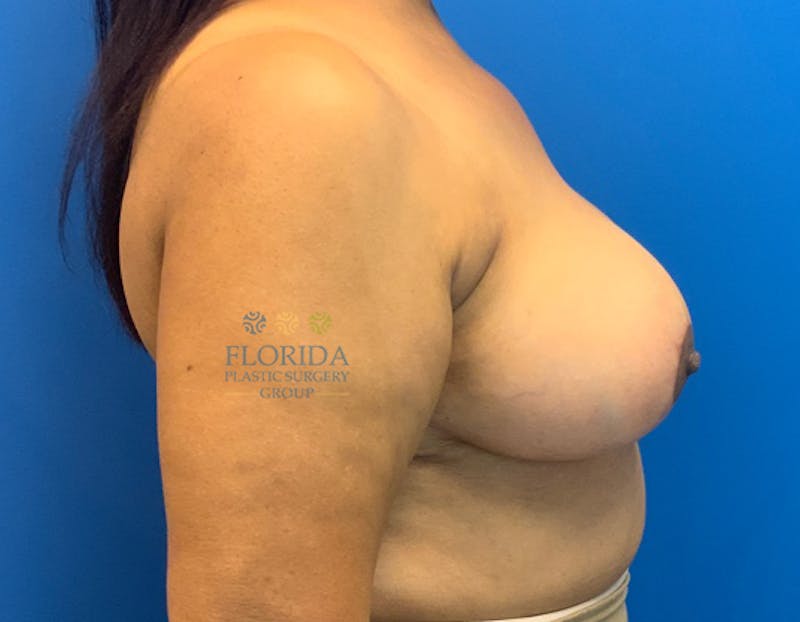 Breast Reduction Before & After Gallery - Patient 154993626 - Image 6