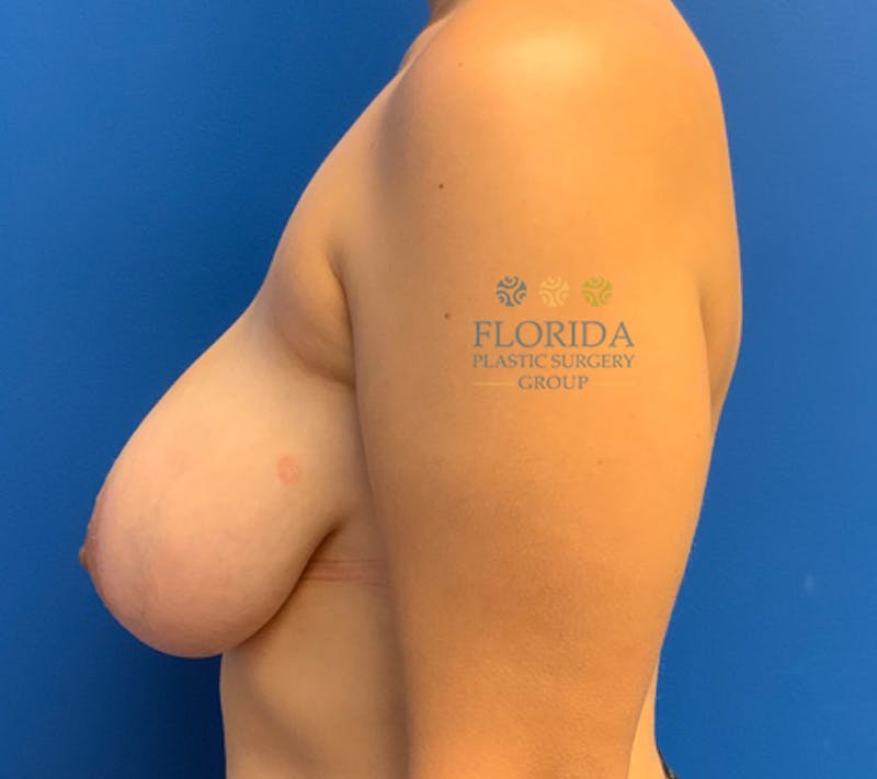 Breast Reduction Before & After Gallery - Patient 154993628 - Image 5