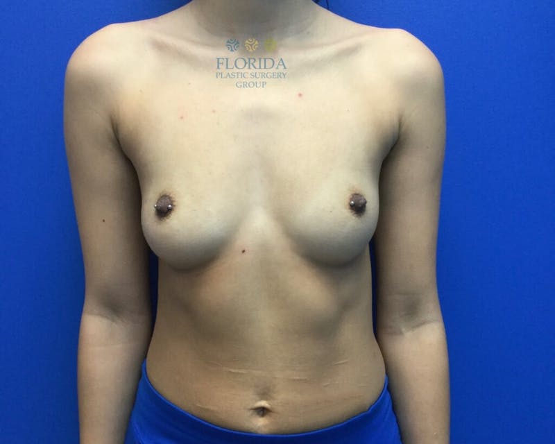 Silicone Breast Augmentation Before & After Gallery - Patient 154993629 - Image 1