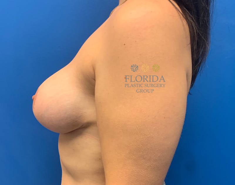 Breast Reduction Before & After Gallery - Patient 154993628 - Image 6