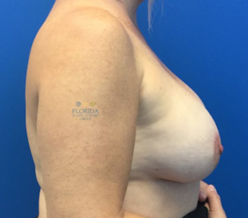 Revision Breast Surgery Before & After Gallery - Patient 154993968 - Image 4