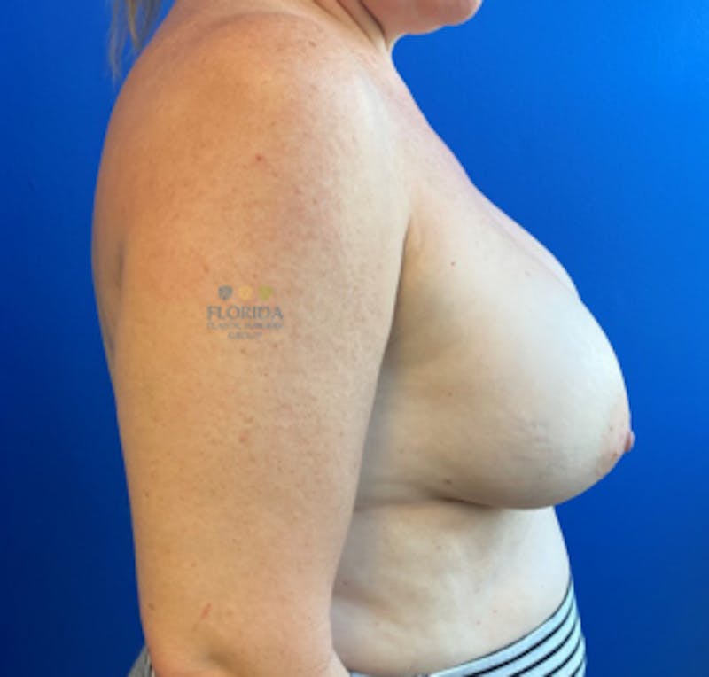Revision Breast Surgery Before & After Gallery - Patient 154993968 - Image 3