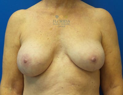 Revision Breast Surgery Before & After Gallery - Patient 154994095 - Image 1
