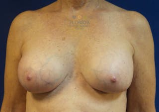 Revision Breast Surgery Before & After Gallery - Patient 154994095 - Image 2