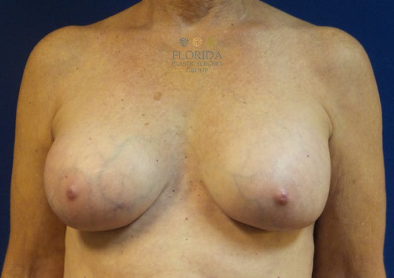 Revision Breast Surgery Before & After Gallery - Patient 154994095 - Image 2