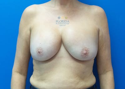 Revision Breast Surgery Before & After Gallery - Patient 154994242 - Image 1