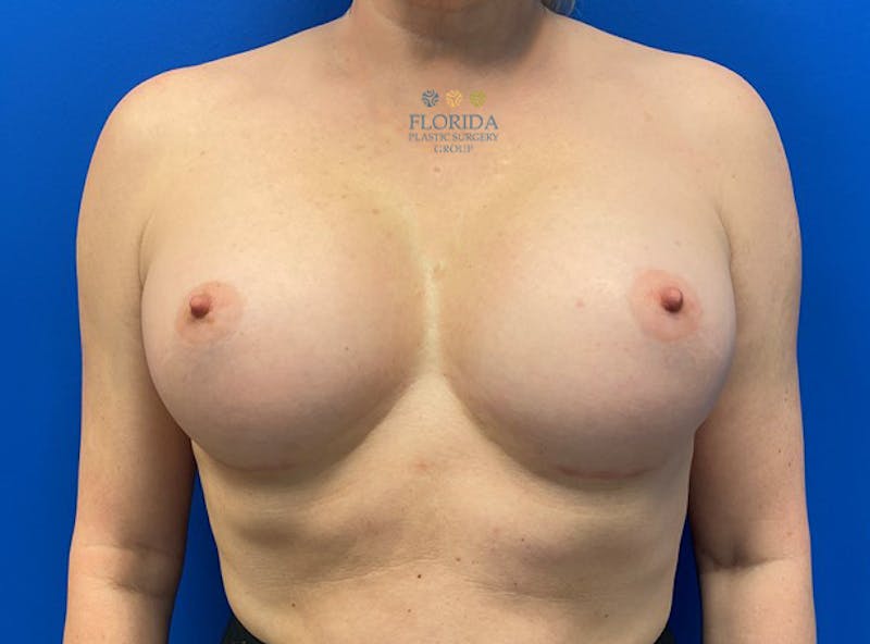 Revision Breast Surgery Before & After Gallery - Patient 154994277 - Image 1